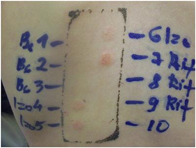 Case Report: DRESS Syndrome Induced by Two Antituberculosis Drugs in an 8-Year-Old Girl